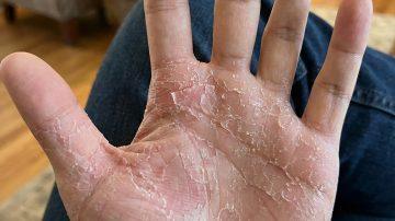 8 Common Signs That May Indicate Your Body Needs More Vitamin B12 – What to Know and How to Respond