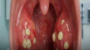 Which Nuts Should You Limit for Better Kidney Health? 3 to Avoid and 3 Smarter Choices